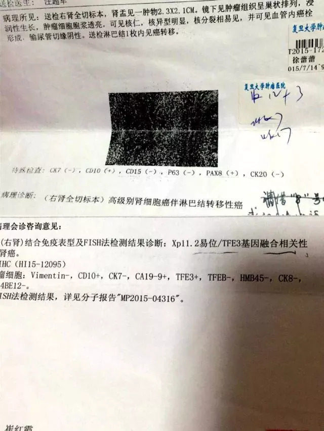 一名肺癌患者20年的抗癌经历,一位患者的真实抗癌经历