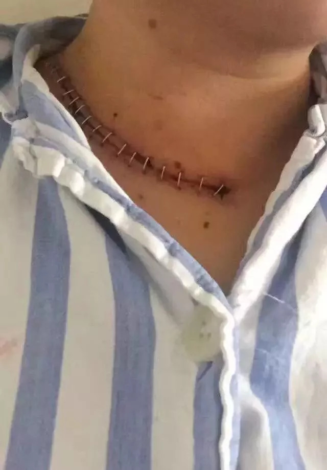 一名肺癌患者20年的抗癌经历,一位患者的真实抗癌经历