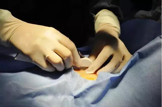 小小一根棒，比套套和上环安全，避孕率超高却少有人知道