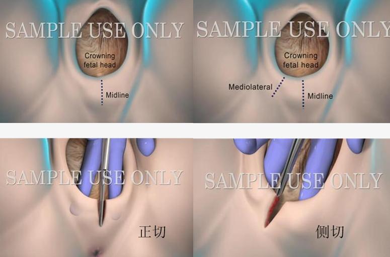 侧切缝合是密集还是间隙缝合的,顺产侧切缝合术操作流程