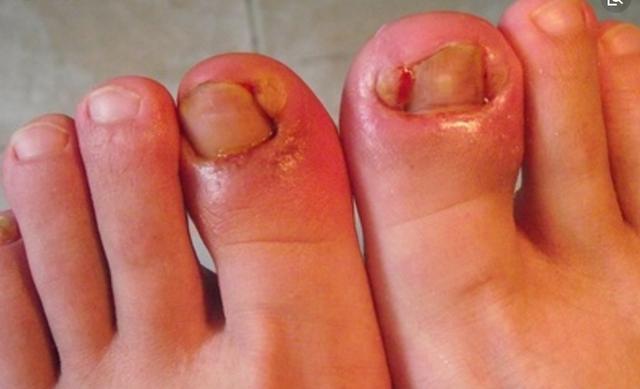 甲沟炎不用去除指甲就能治疗,严重的甲沟炎不拔甲能治好吗