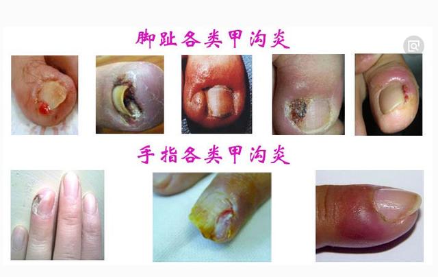 甲沟炎不用去除指甲就能治疗,严重的甲沟炎不拔甲能治好吗