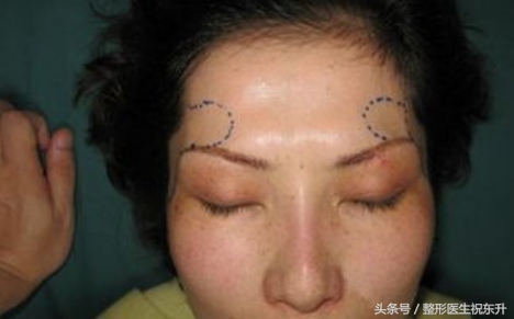 太阳穴怎么填充显脸小,脂肪填充的真相