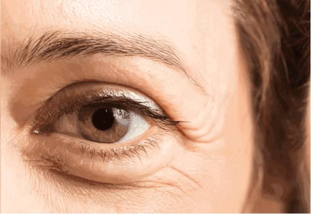 黑眼圈没办法吗,黑眼圈怎么不靠化妆消除