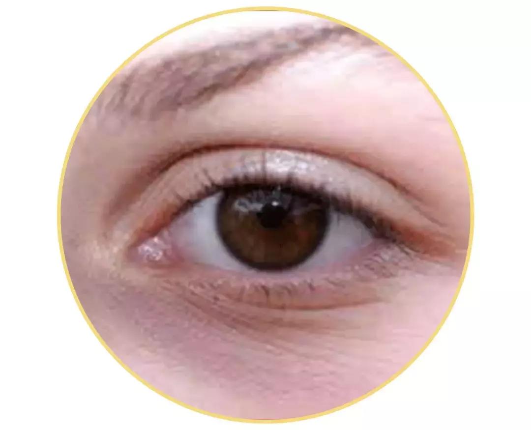 黑眼圈没办法吗,黑眼圈怎么不靠化妆消除