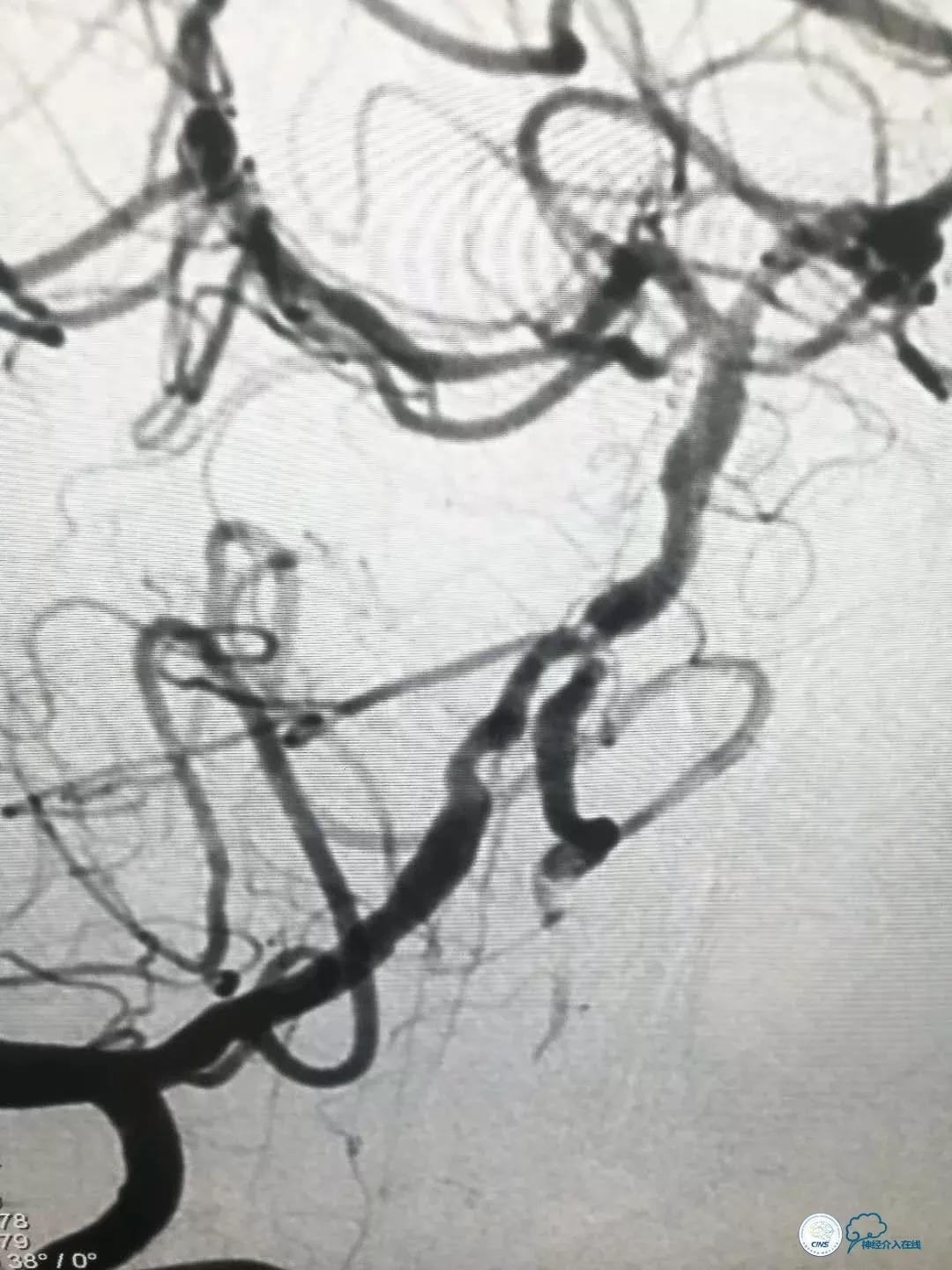 基底动脉重度狭窄介入治疗的风险,椎基底动脉重度狭窄的保守治疗