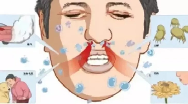 儿童好用的鼻炎喷剂,日本儿童鼻炎喷雾药