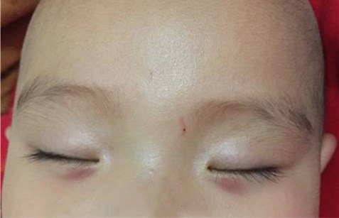 小孩感冒咳嗽眼睛有什么变化,小孩常流鼻涕咳嗽是什么原因