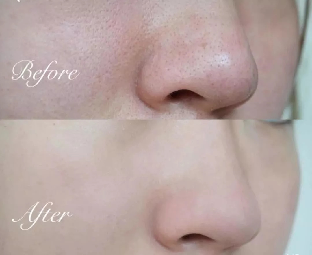 睡一觉毛孔都隐形?顺便还白了2个度,这款整形面膜我服了……