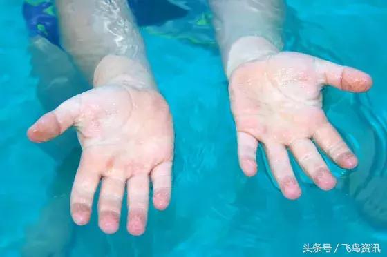 手指为什么泡水特别容易烂,手指泡水后发白像烂了