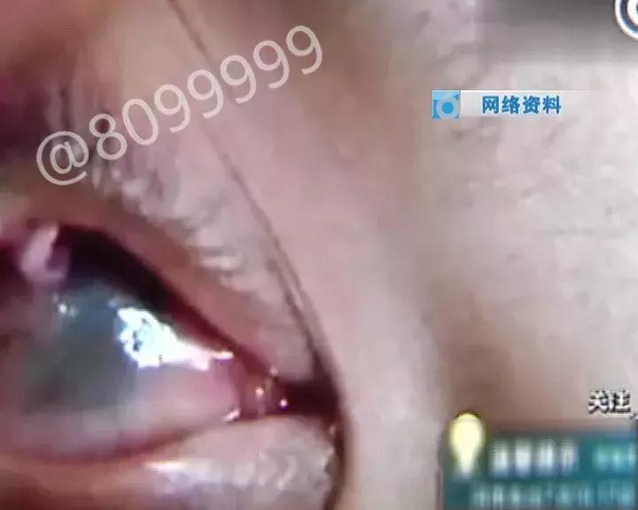 男童玩干燥剂致失明,干燥剂爆炸小孩受伤