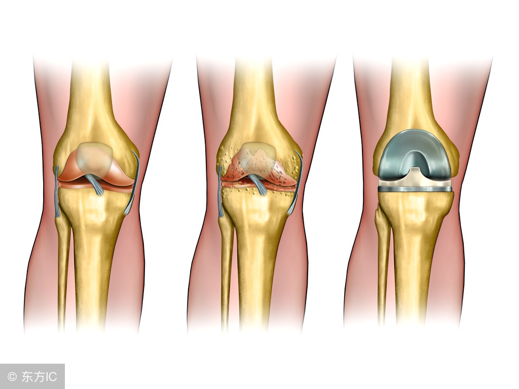 膝关节置换手术一般怎么做,膝关节置换没做到这些别轻易手术