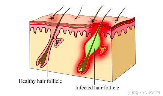 头皮和身上长痘,头皮油脸长痘