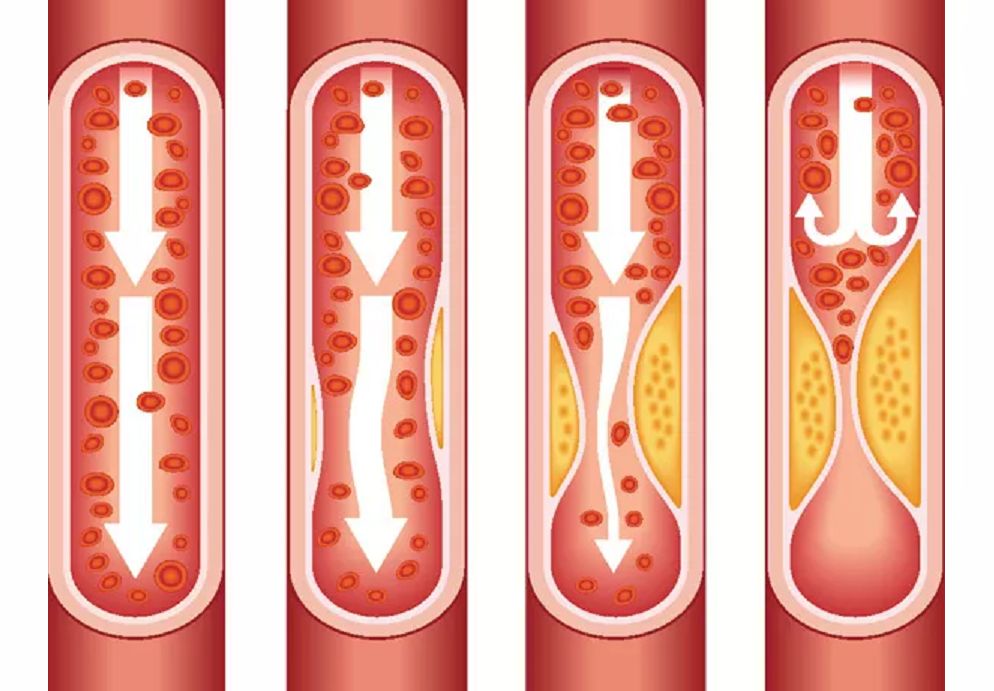 血管堵不堵从这些地方一看就知道,血管堵不堵两个动作就知道