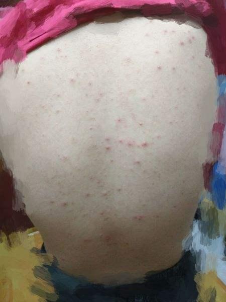 如何快速去除背后的螨虫痘,有什么方法可以去除背后螨虫