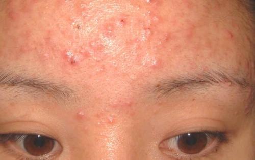 如何快速去除背后的螨虫痘,有什么方法可以去除背后螨虫