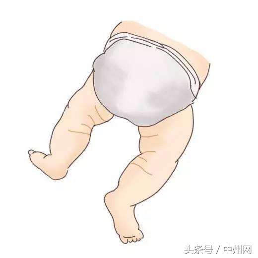 3个月体检臀纹不对称会影响什么,11个月宝宝臀纹不对称挂什么科