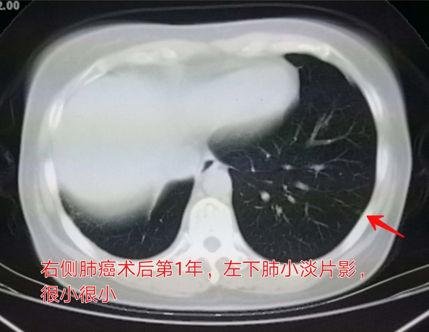 几毫米的肺结节需要随访,5毫米肺结节随访一年无变化