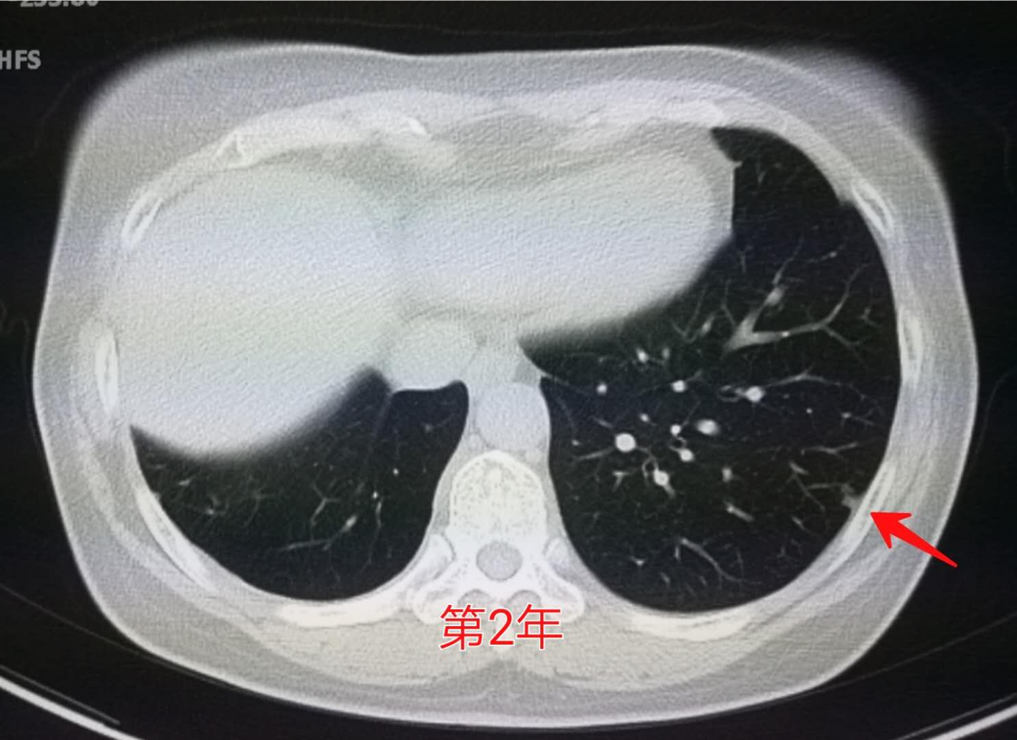 几毫米的肺结节需要随访,5毫米肺结节随访一年无变化