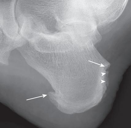 世界银屑病日银屑病关节炎,银屑病关节炎是银屑病后期吗
