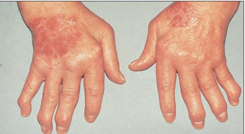 世界银屑病日银屑病关节炎,银屑病关节炎是银屑病后期吗