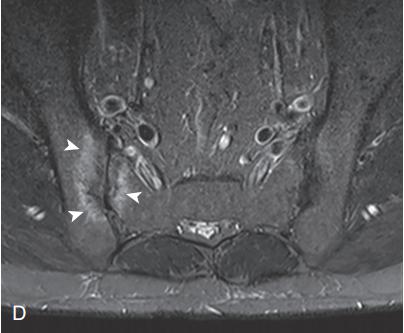 世界银屑病日银屑病关节炎,银屑病关节炎是银屑病后期吗
