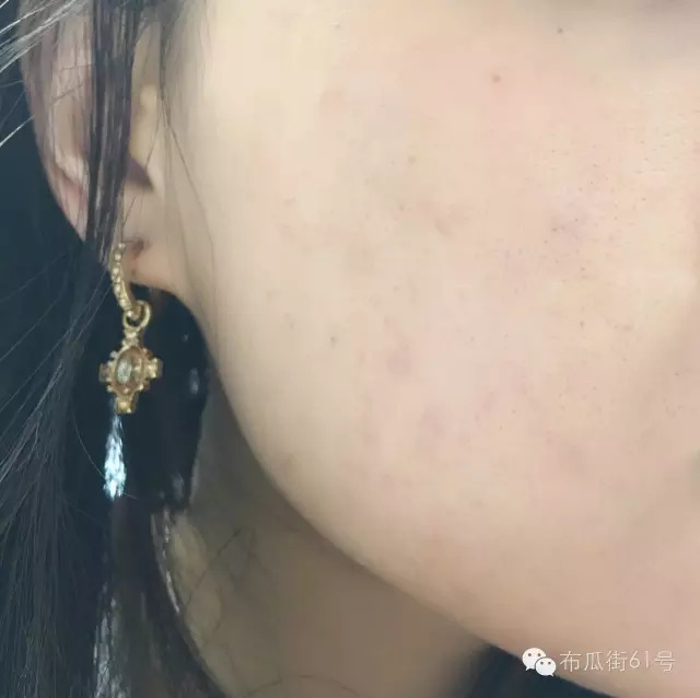 闭口痘痘怎么消除毛孔粗大,闭口大痘痘最好最快的消除方法