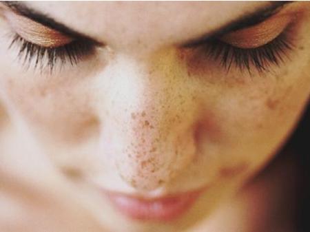 褐青色斑后用什么面膜,褐青斑和雀斑哪个更好祛