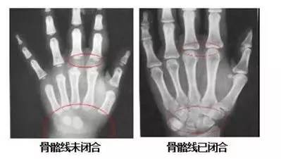 孩子性早熟会长不高！出现这3个特征要当心！