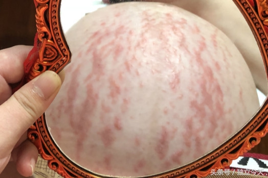 33岁怀孕第一胎需要注意什么,33岁长妊娠纹的概率