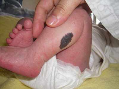 宝宝常见胎记草莓斑,宝宝胎记皮脂腺痣