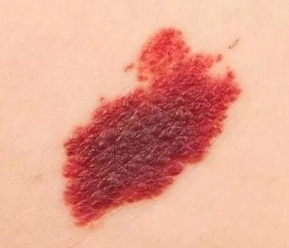 宝宝常见胎记草莓斑,宝宝胎记皮脂腺痣