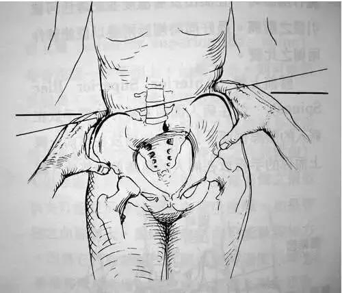 一招解决腿不直的方法,腿不直怎么1个动作矫正