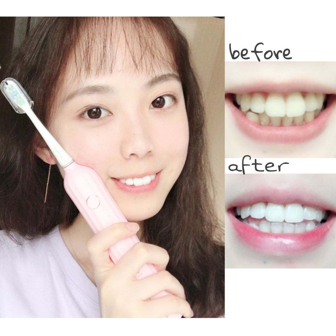牙齿美白终极指南,白牙超级美白