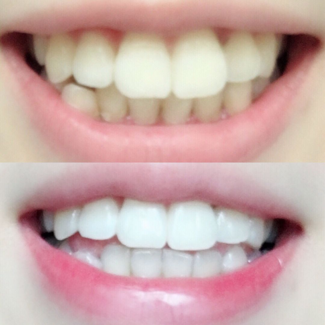 牙齿美白终极指南,白牙超级美白