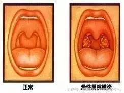儿童扁桃体发炎家长怎么看,家长怎么检查小朋友扁桃体红肿