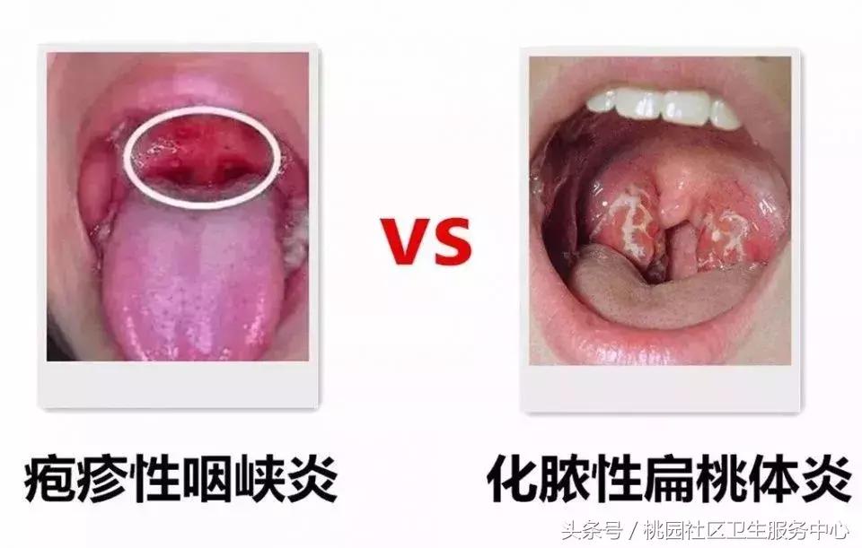儿童扁桃体发炎家长怎么看,家长怎么检查小朋友扁桃体红肿