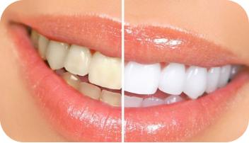 烤瓷牙的保修期是多长时间,烤瓷牙的保修期一般多久