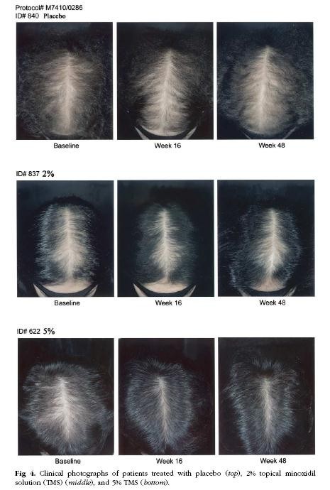 5个原因导致男人脱发,雄激素性脱发能治吗