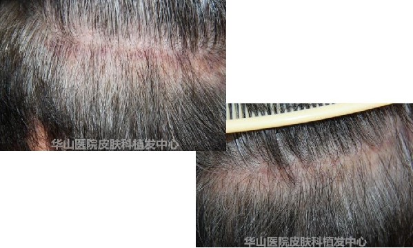 5个原因导致男人脱发,雄激素性脱发能治吗