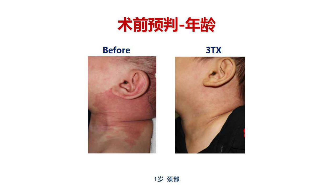 刚刚出生婴儿脸上长了肉痣怎么办,8个月宝宝脸上长雀斑样痣