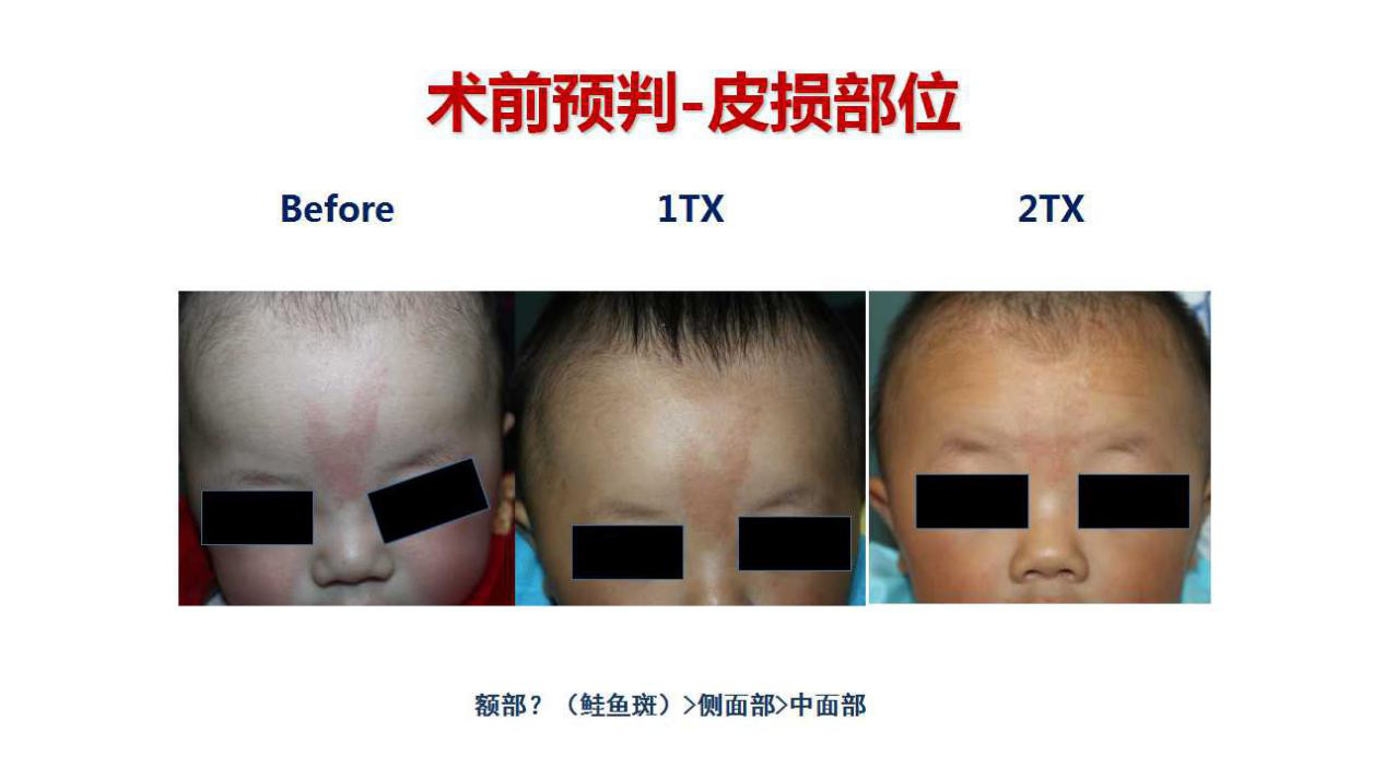 刚刚出生婴儿脸上长了肉痣怎么办,8个月宝宝脸上长雀斑样痣