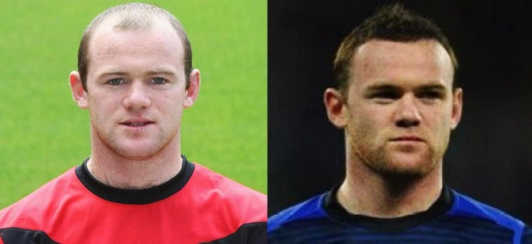 脱发严峻发际线危机,全国脱发情况