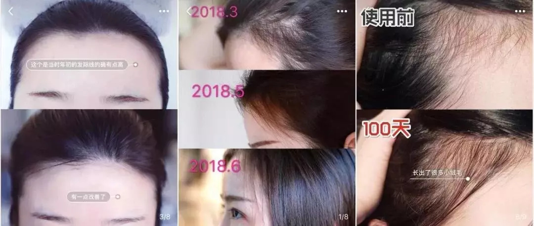 万事屋推荐｜不想变秃的十二星座，这可能是目前为止世界上最有效的生发方案