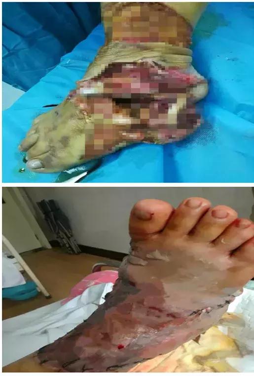 邯郸骨科医院成功为一被六吨钢板砸伤的危重患者进行右足再造手术