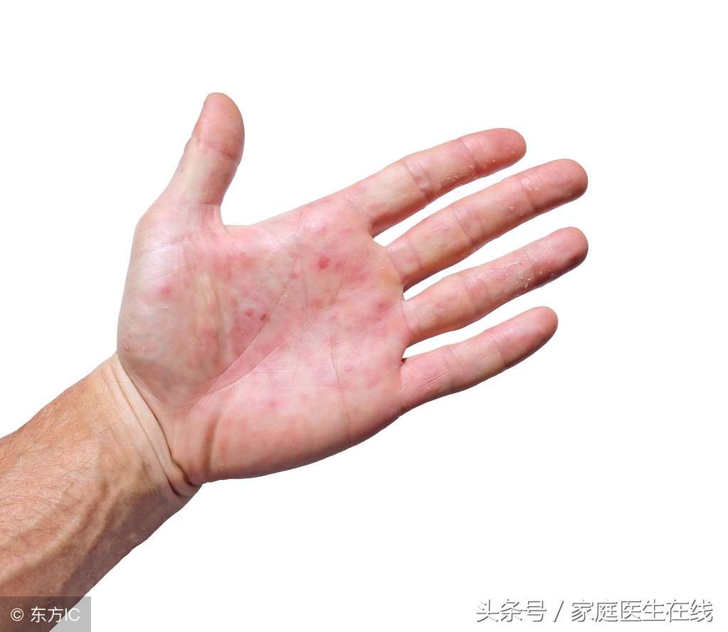 手上起小红点儿是什么,手上起小红点还痒是什么病