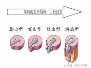 第四期，腰椎间盘突出你最该知道的事！