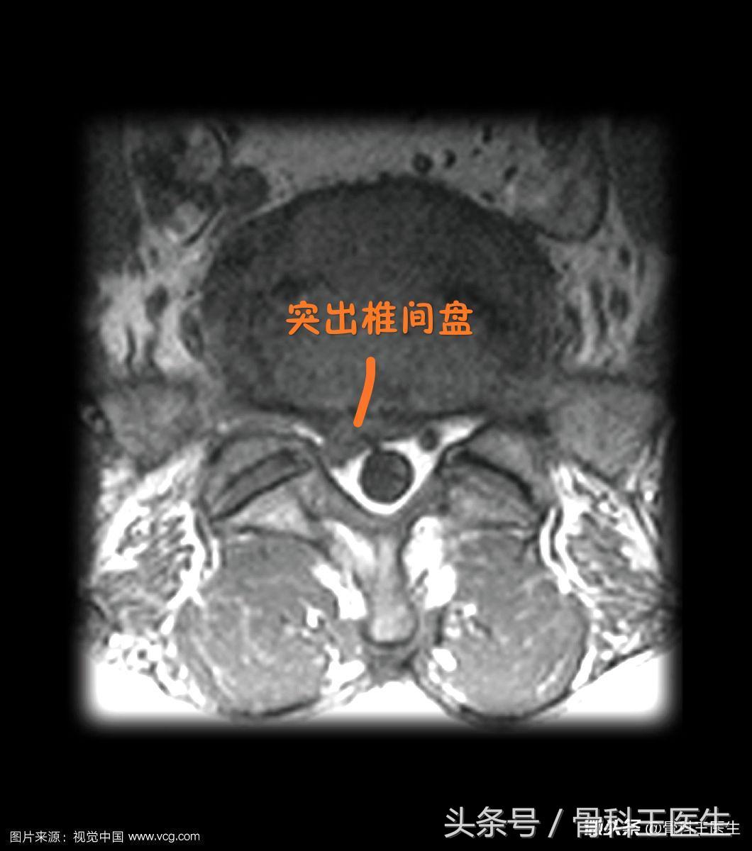 第四期，腰椎间盘突出你最该知道的事！