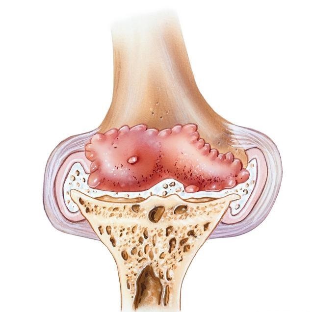 治疗颈椎骨质增生有效方法,关节骨质增生怎么治疗最有效