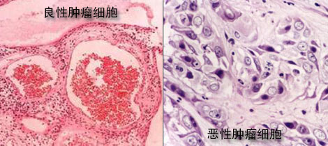 在不久的将来癌症能攻破吗,预测未来多少年可以治愈癌症